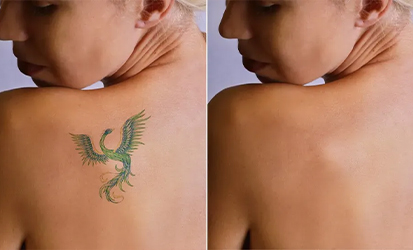 Tattoo Removal